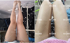 煙臺鵬愛整形醫(yī)院大腿吸脂前后對比案例