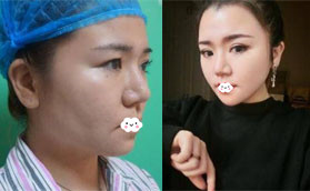 千萬別做光纖吸脂？我找深圳美芮王權做面部吸脂半年變化