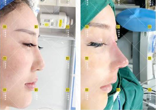 深圳江南陽光隆鼻失敗修復手術(shù)價格合理 找羅雄鵬做鼻綜合