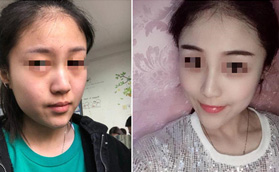 武漢檸悅給我做的12800元鼻綜合很靠譜，前后對(duì)比照片也自然