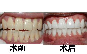 長(zhǎng)沙星雅整形醫(yī)院牙齒冷光美白案例