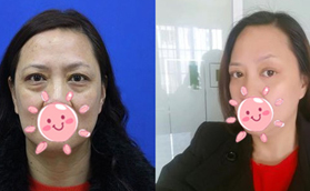 外切去眼袋后的疤痕無法愈合?并不會，這有真人案例參考哦