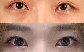 韓國(guó)TS整形外科的眼修復(fù)怎么樣?李相均雙眼皮整形特點(diǎn)如下